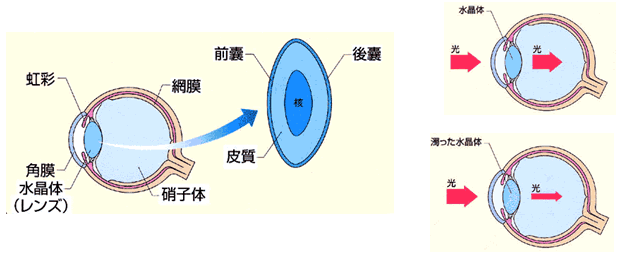 白内障