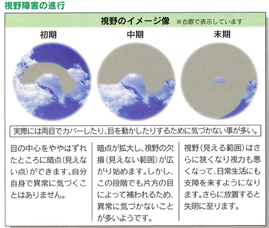 緑内障